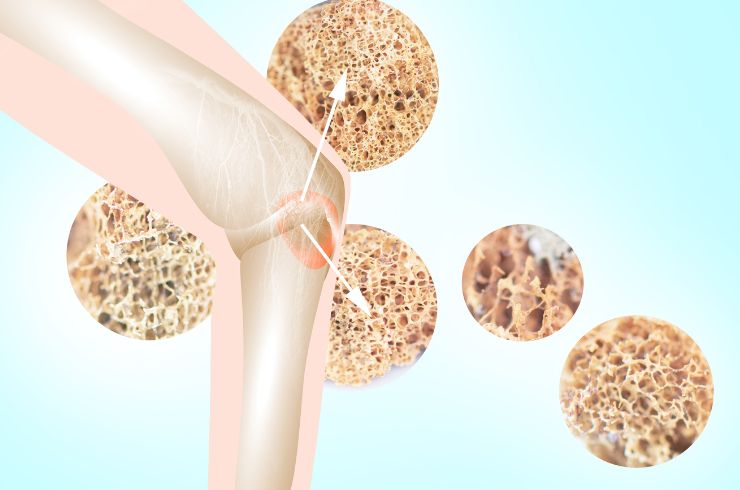 Basic Bone Health Screening